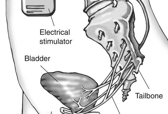 electrical stimulation